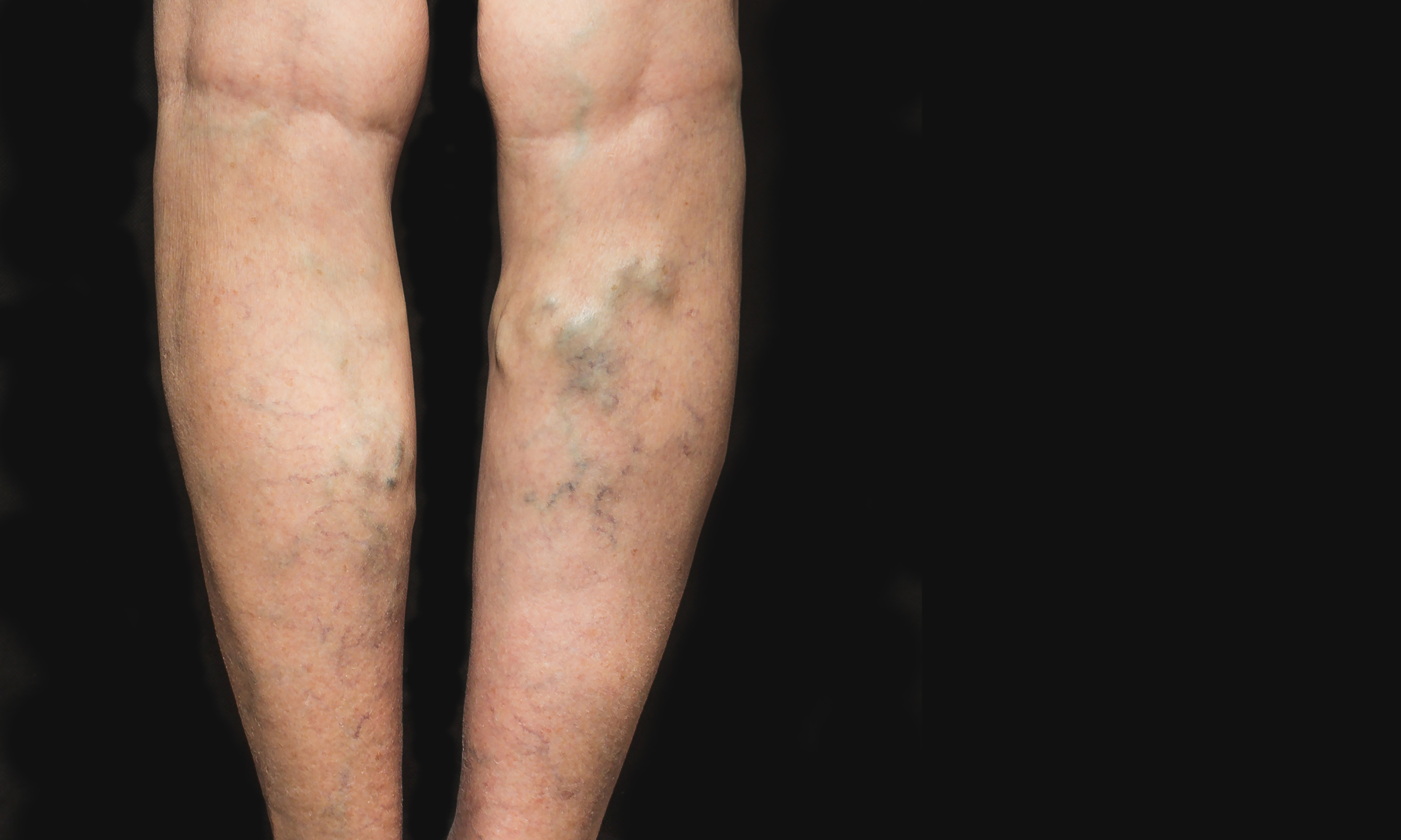 Varicose Veins: What you should know
